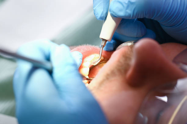 Best Emergency Wisdom Teeth Removal in Henryville, IN